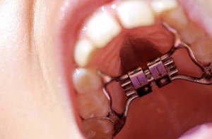Palatal Expanders and Children - Parks Orthodontics