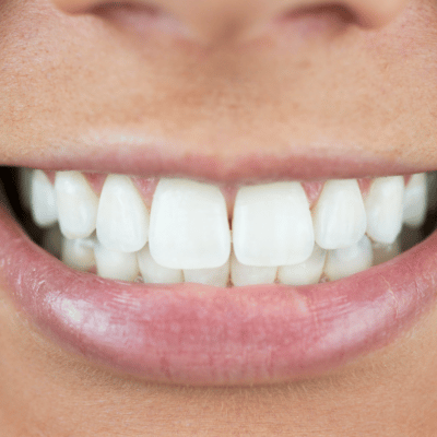 straight teeth Parks Orthodontics
