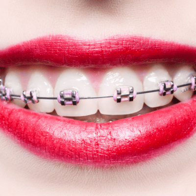 closeup of woman's mouth with braces