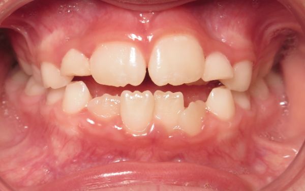Parks Orthodontics Early Treatment Patient 11 - Before