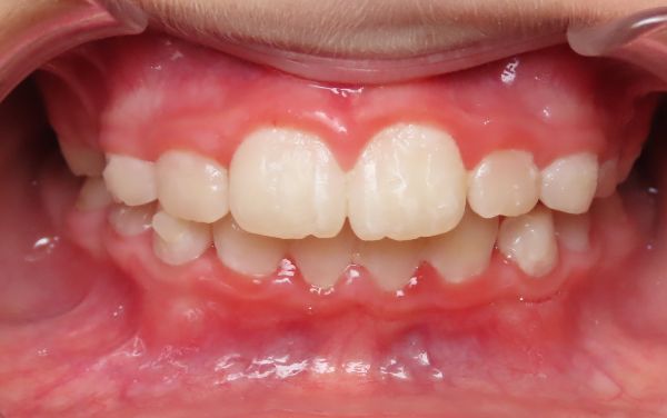 Parks Orthodontics Early Treatment Patient 11 - Progress