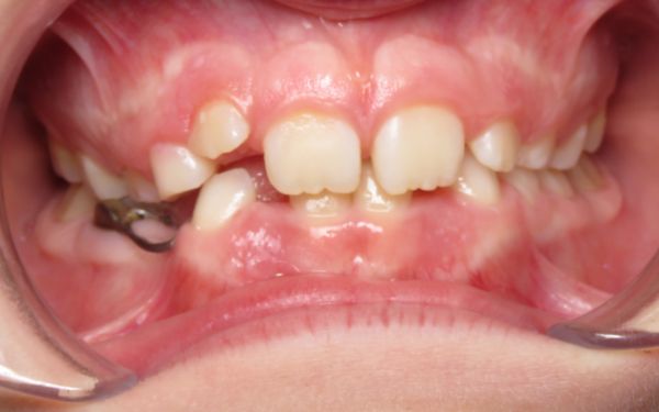 Parks Orthodontics Early Treatment Patient 12 - Before