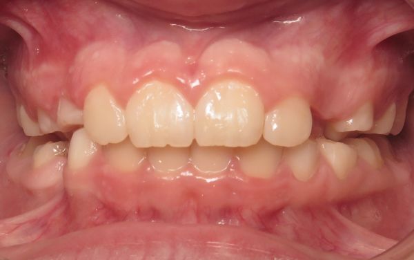 Parks Orthodontics Early Treatment Patient 12 - Progress