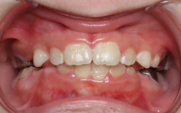 Parks Orthodontics Early Treatment Patient 13 - Progress