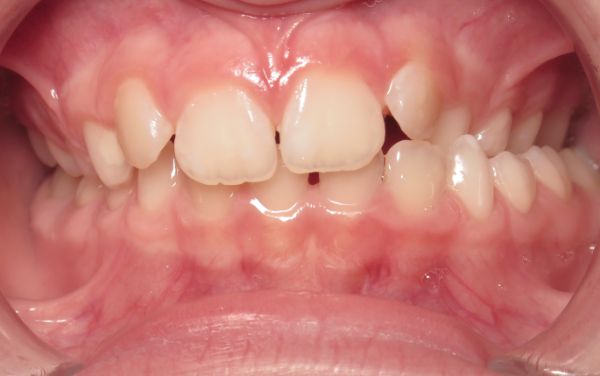 Parks Orthodontics Early Treatment Patient 14 - Before