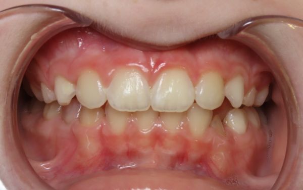 Parks Orthodontics Early Treatment Patient 14 - Progress
