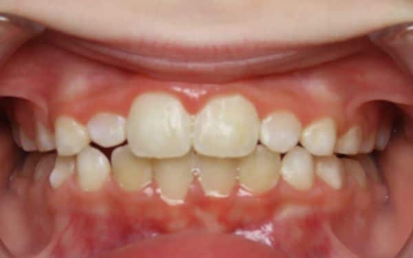 young patient smile after smile treatment
