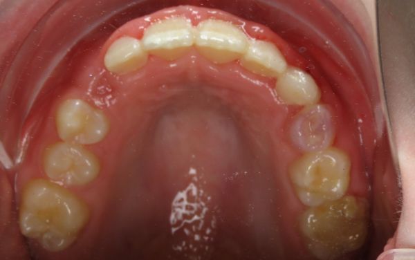 Parks Orthodontics Early Treatment Patient 5 - Progress