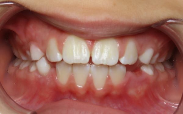 Parks Orthodontics Early Treatment Patient 7 - Progress