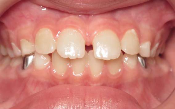 Parks Orthodontics Early Treatment Patient 8 - Before