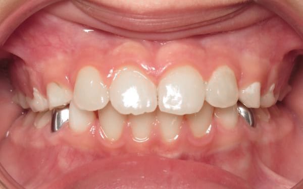 Parks Orthodontics Early Treatment Patient 8 - Progress