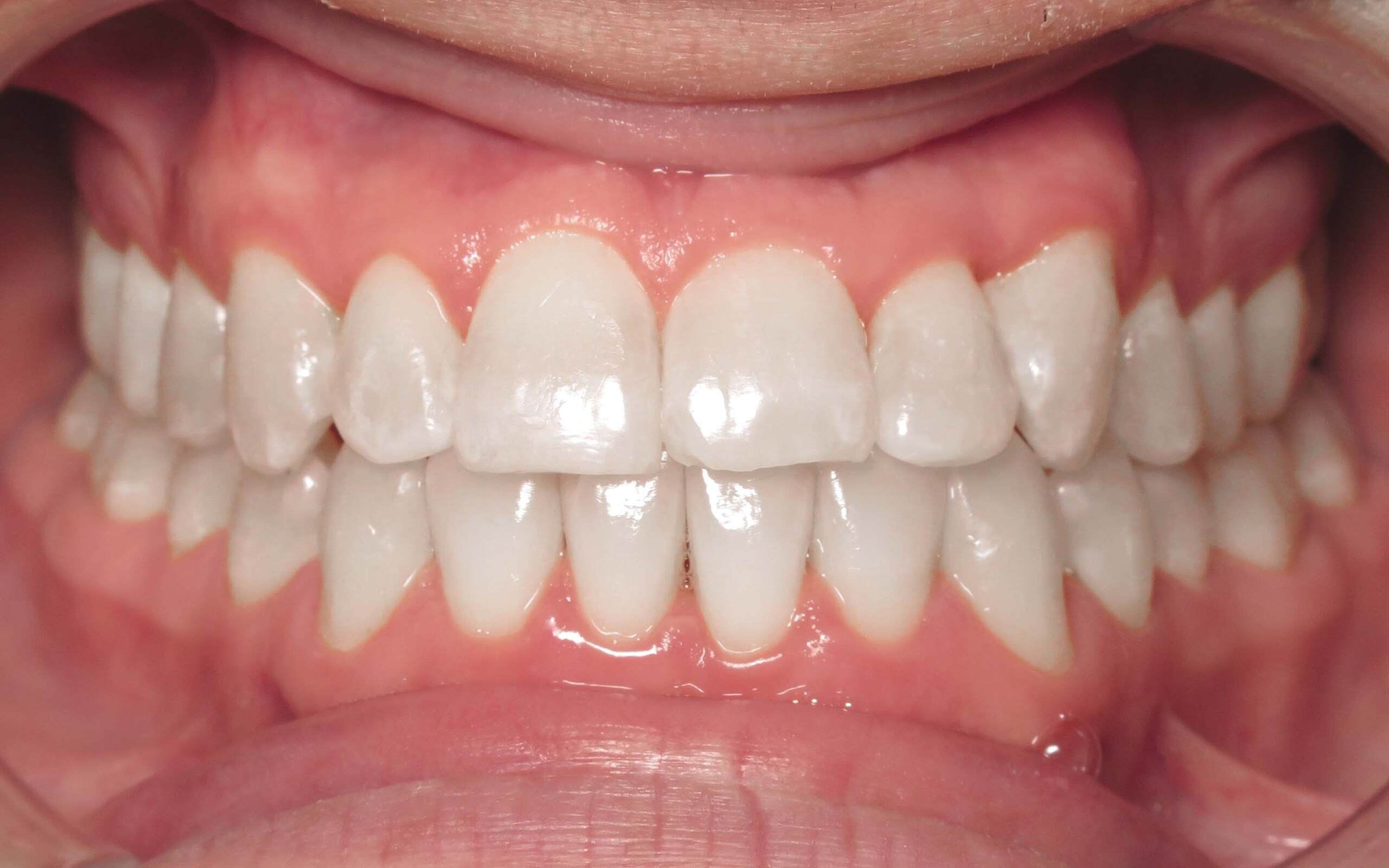 Parks Orthodontics Invisalign Patient 15 - After