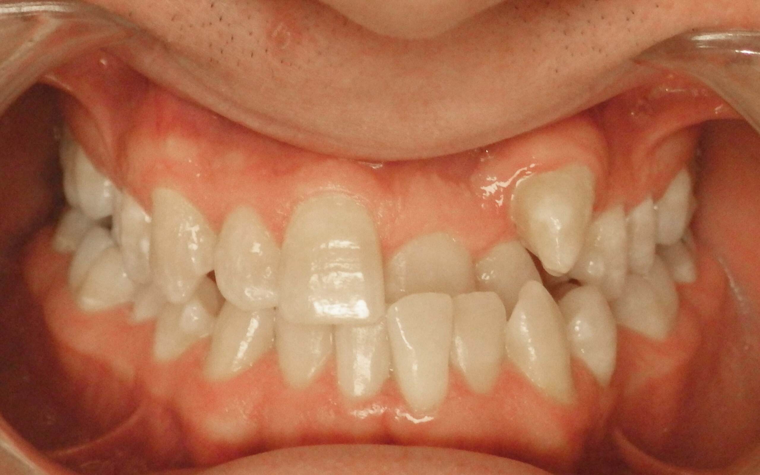 Parks Orthodontics Invisalign Patient 15 - Before