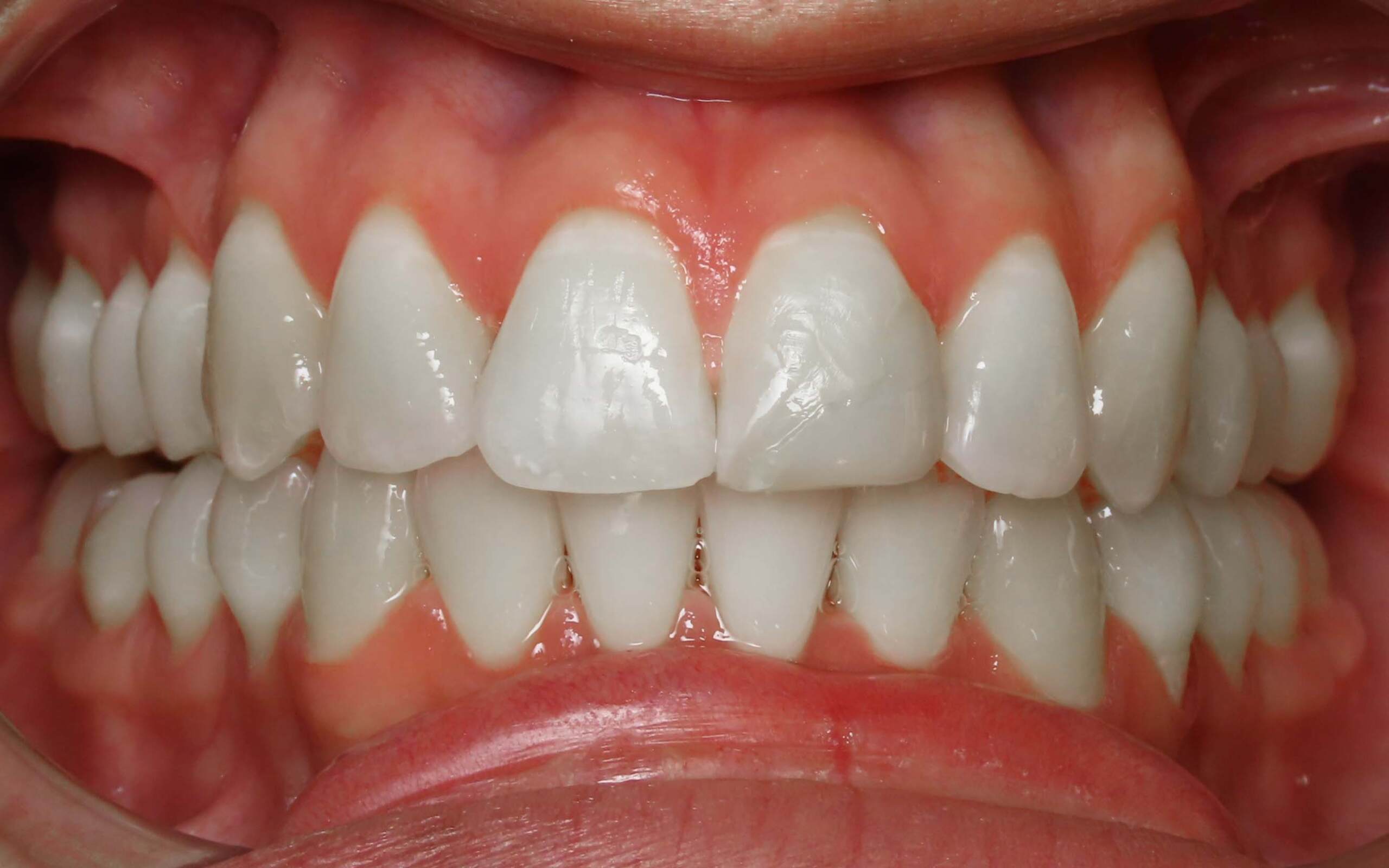 Parks Orthodontics Invisalign Patient 16 - After