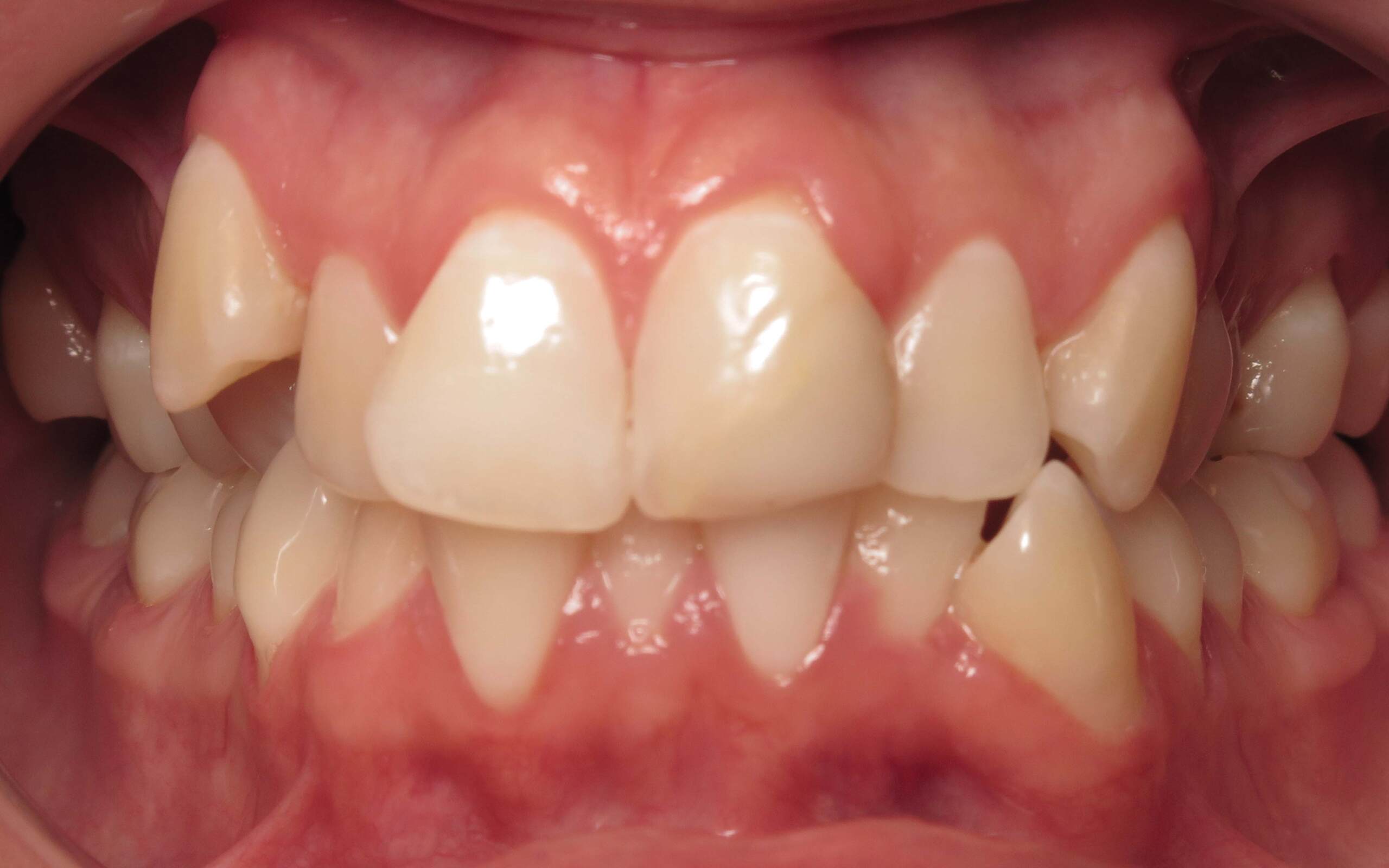 Parks Orthodontics Invisalign Patient 16 - Before