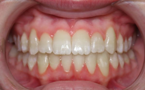 Parks orthodontics patient teeth after treatment