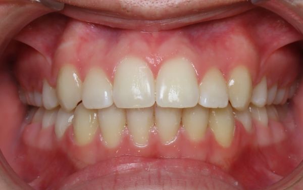 Parks orthodontics patient teeth after braces