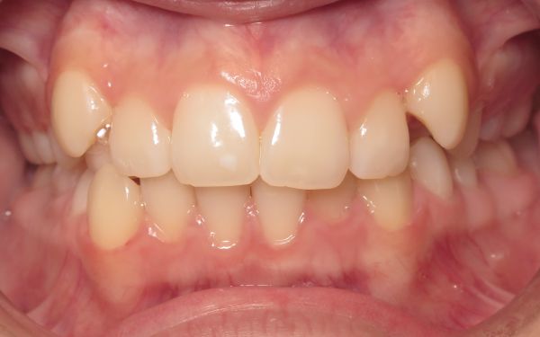 Parks orthodontics patient teeth before braces