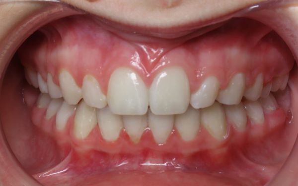 Parks orthodontics patient teeth after orthodontic treatments