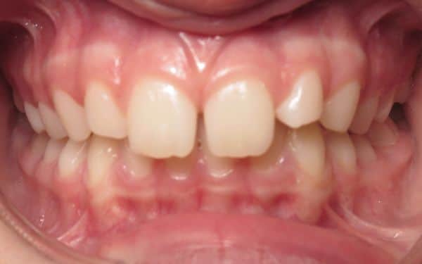 Parks orthodontics patient teeth before orthodontic treatments