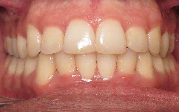 Patient teeth after smile adjustment Parks Orthodontic