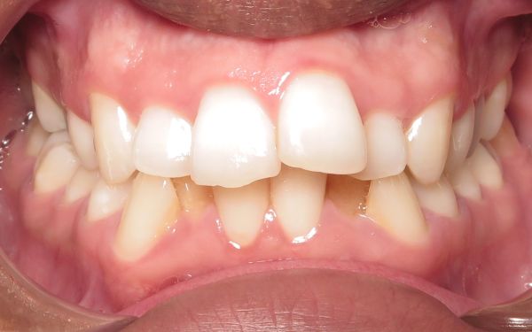 Patient teeth before smile adjustment Parks Orthodontic