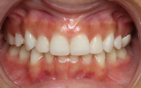 Patient teeth after adjustment Parks Orthodontic