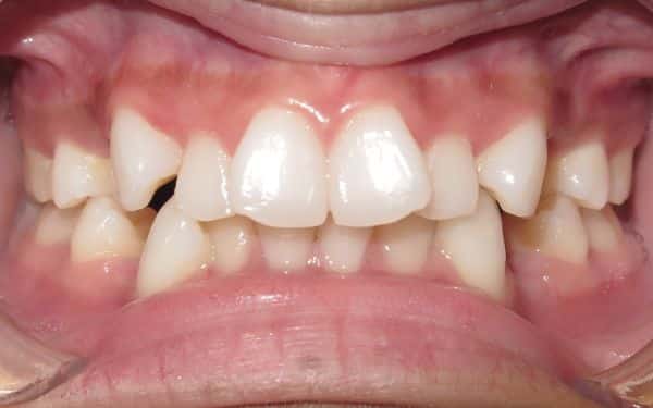 Patient teeth before orthodontic adjustment Parks Orthodontic