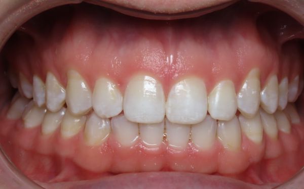 Patient teeth after adjustment Parks Orthodontic