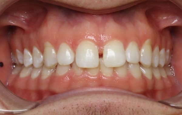 Patient teeth before adjustment Parks Orthodontic
