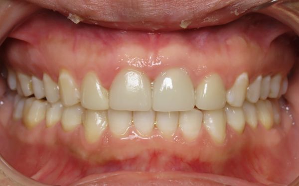 Patient teeth after braces adjustment Parks Orthodontic