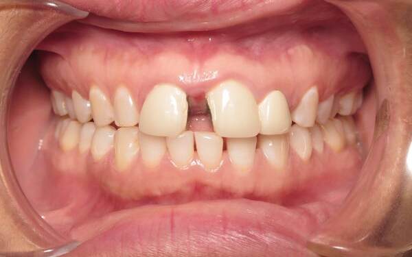 Patient teeth before braces adjustment Parks Orthodontic