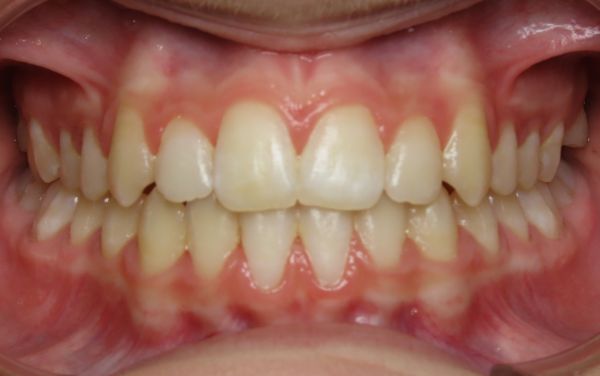 young patient smile after treatment