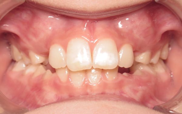 young patient smile before treatment