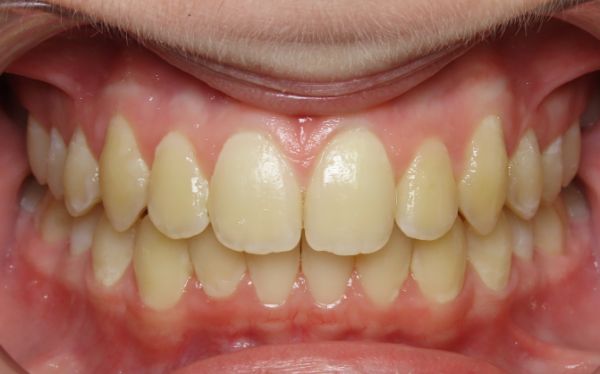 young patient smile after orthodontic treatment