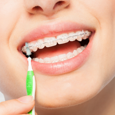 Person cleaning braces, representing adult orthodontics